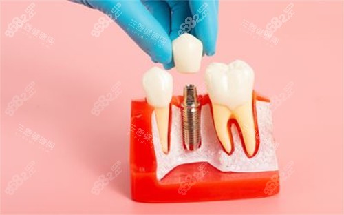 種植牙模型展示圖