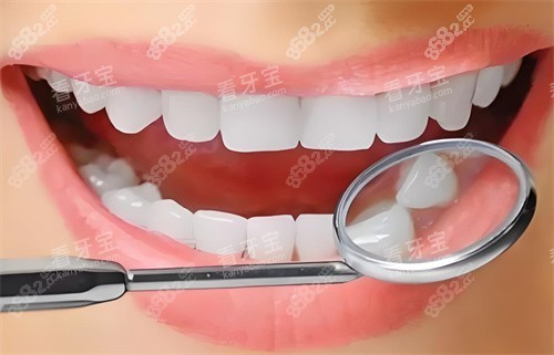 牙齒檢查圖片展示