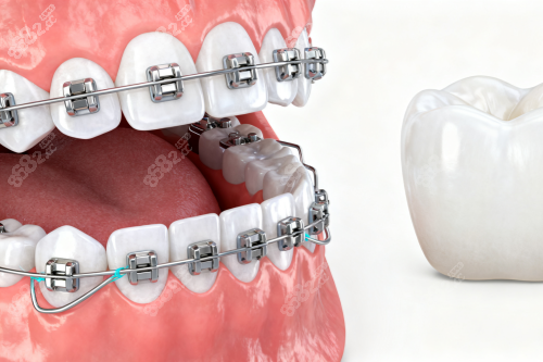 牙齒矯正卡通展示圖