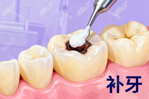 補(bǔ)牙卡通展示圖