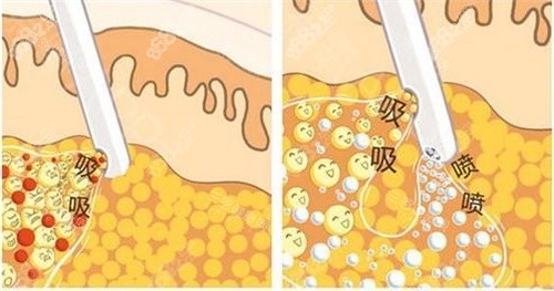 抽脂手術(shù)抽脂方式動(dòng)畫(huà)演示圖