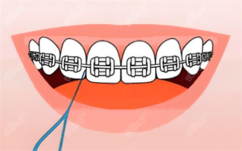 金屬牙齒矯正卡通圖片