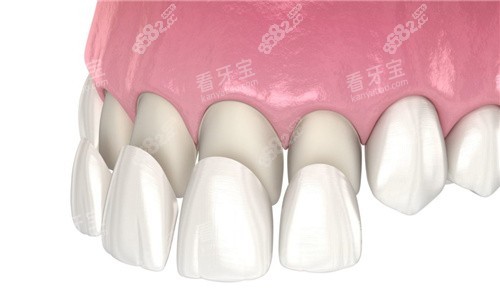 前牙四顆牙齒貼面