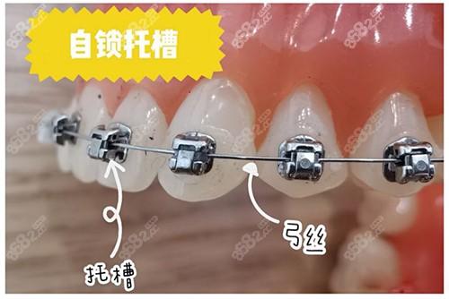 牙齒矯正自鎖托槽牙套