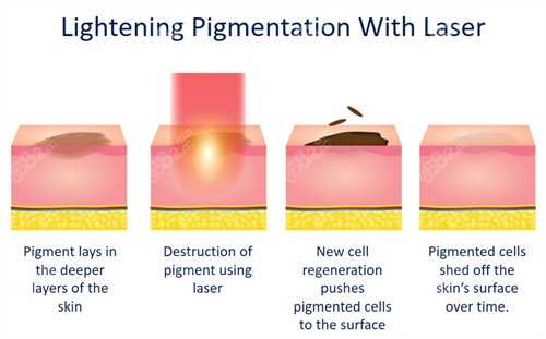 激光祛斑如何改善皮膚斑點