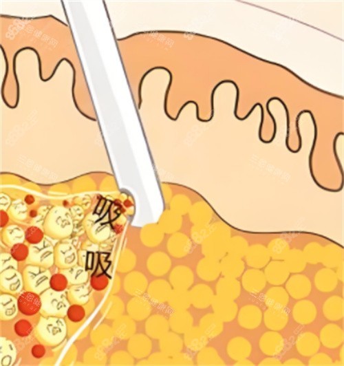 吸脂手術(shù)動(dòng)畫