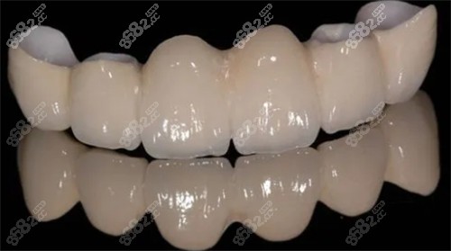 烤瓷牙的顏色和光澤
