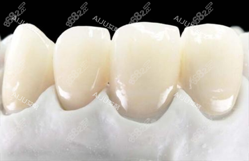全瓷牙前牙展示