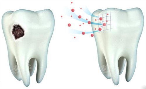 牙齒牙釉質(zhì)齲壞和正常牙釉質(zhì)