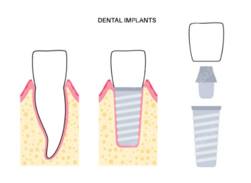 種植牙前后對比圖片