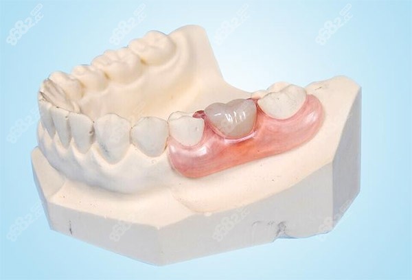 成都老人鑲牙多少錢？整理了樹脂牙、鈦合金及種植假牙的詳細(xì)價(jià)格