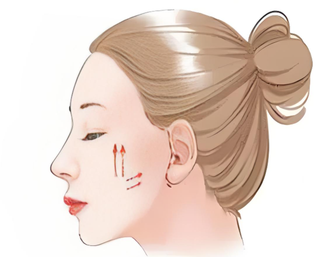 拉皮手術(shù)的原理與優(yōu)勢