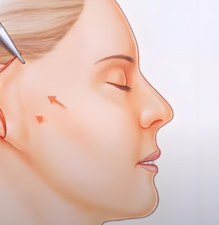 拉皮手術(shù)項(xiàng)目的介紹