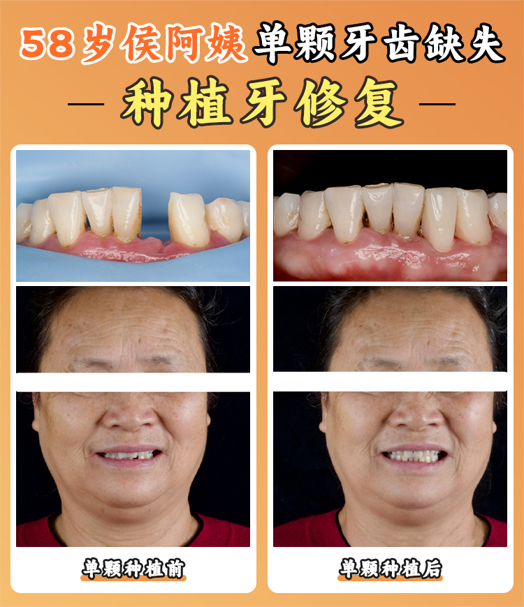 選擇卡爾斯種植牙需要注意什么？