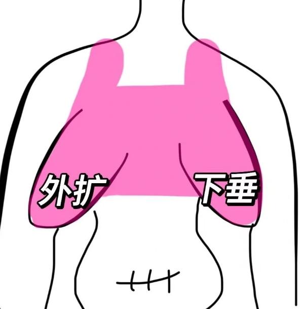 五、縮胸手術(shù)后的變好與護(hù)理