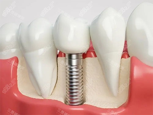 種植牙模型解刨圖