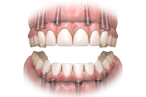all-on-6全口種植牙示意圖