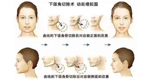 王濤醫(yī)生下頜角整形手術(shù)怎么樣？解析其“超長曲線截骨”技術(shù)特色與審美