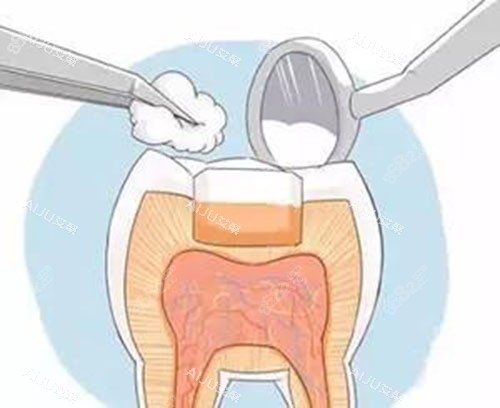 補(bǔ)牙后示意圖