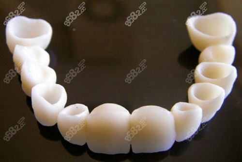 半口全瓷牙冠示意圖