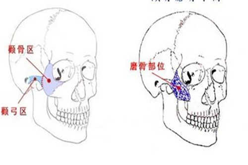 顴骨磨骨手術示意圖