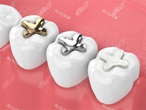 不同材質(zhì)的補(bǔ)牙材料