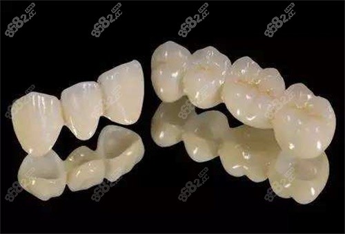 2026全瓷牙品牌哪個(gè)好？深度對比威蘭德/澤康/Lava及國產(chǎn)全瓷牙優(yōu)缺點(diǎn)