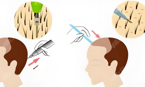 后枕部位取毛囊植發(fā)展示.jpg