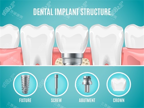 種植牙植體組成部分展示