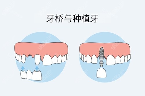 牙冠橋和種植牙對比圖