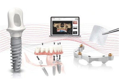 諾貝爾種植牙02
