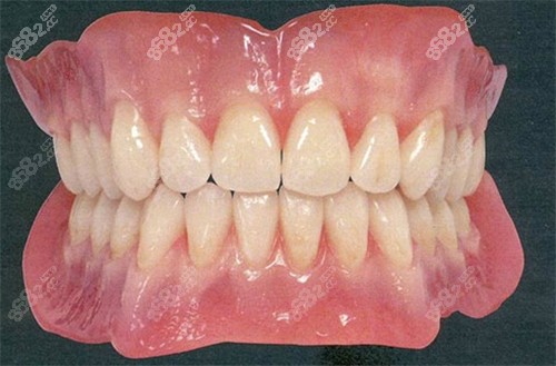 還原真牙的全瓷牙
