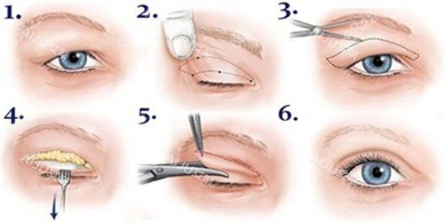 雙眼皮全切術(shù)過程圖