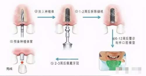 種植牙的6個步驟圖解