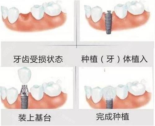 種植牙的手術(shù)過程