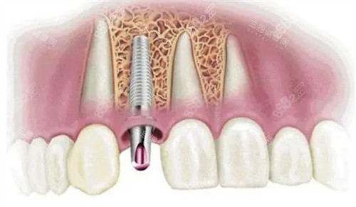 種植牙動畫模擬圖