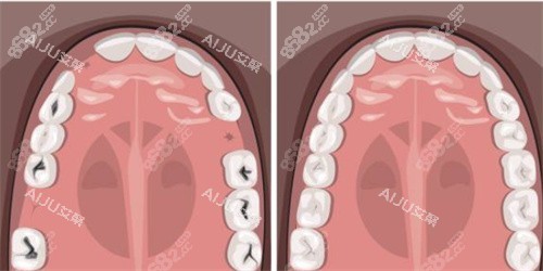 牙齒缺失補(bǔ)牙示意圖