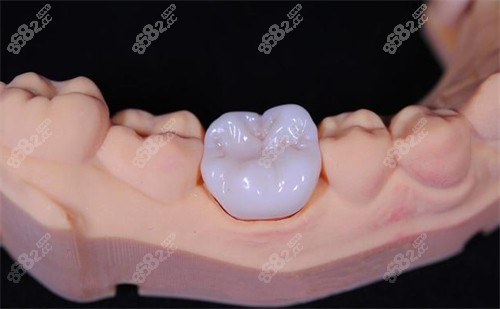 全瓷牙冠