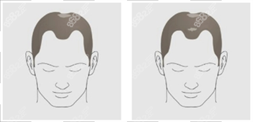 發(fā)際線及頭頂頭發(fā)脫落素材