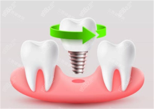 種植牙擰在牙床圖