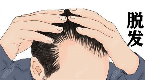 發(fā)際線后移