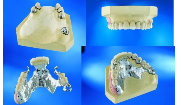烏魯木齊鑲牙就選烏市鑲牙便宜又好的牙科,技術(shù)好價格好實惠