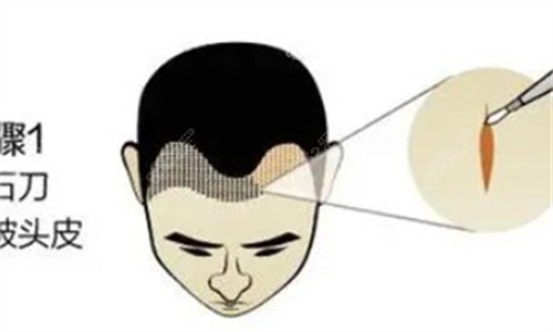 植發(fā)際線 植發(fā)際線