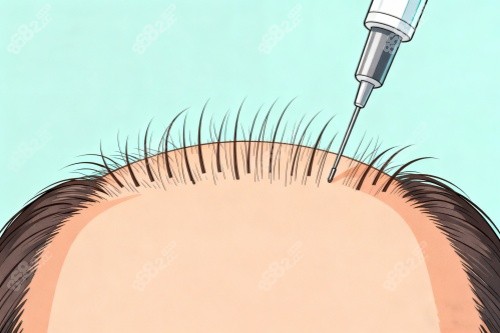 發(fā)際線種植卡通圖 發(fā)際線種植卡通圖