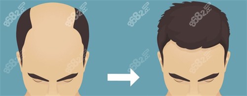 種發(fā)際線前后對比 種發(fā)際線前后對比