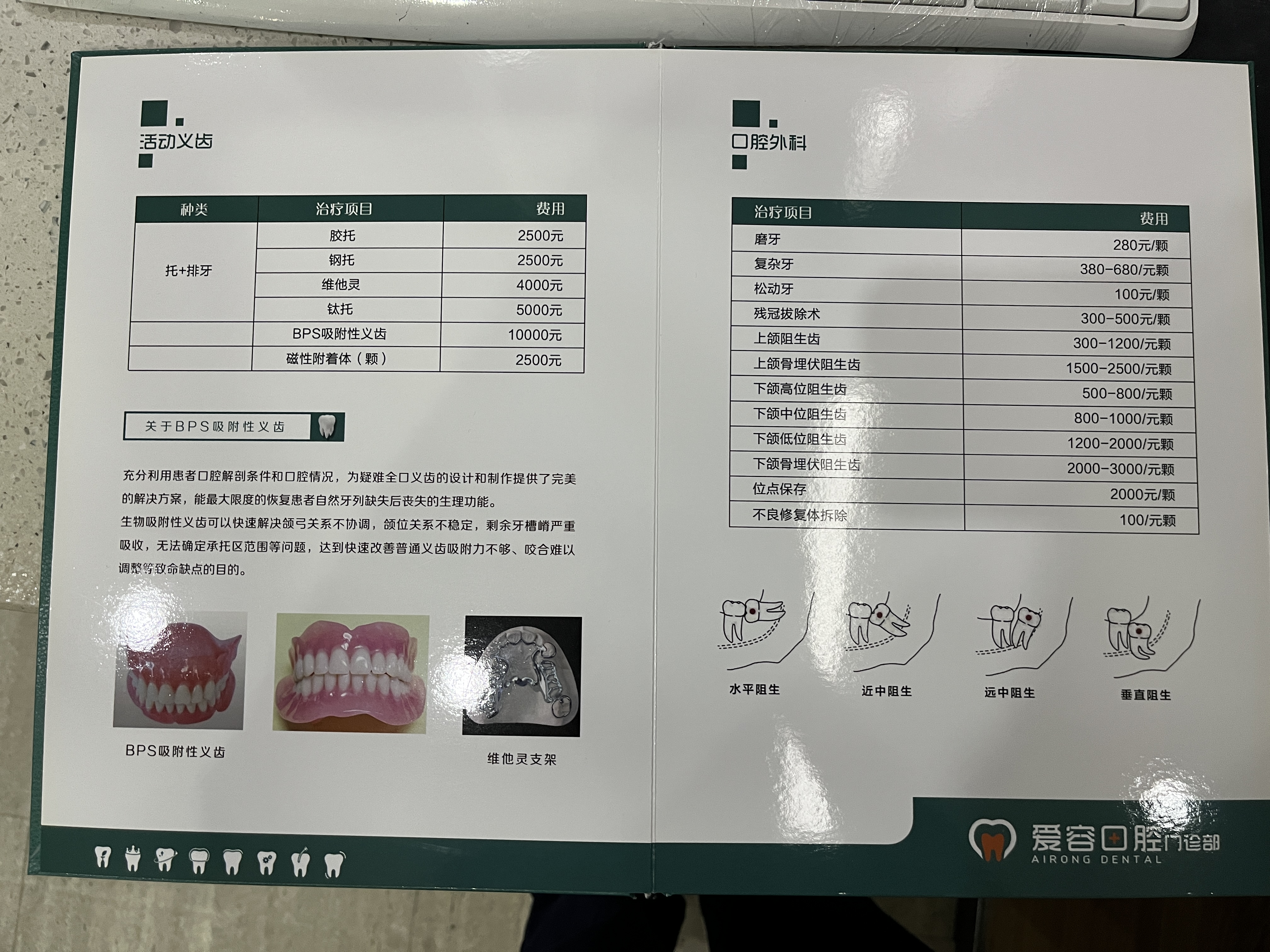 補(bǔ)牙項(xiàng)目?jī)r(jià)格：根據(jù)齲壞程度定價(jià)