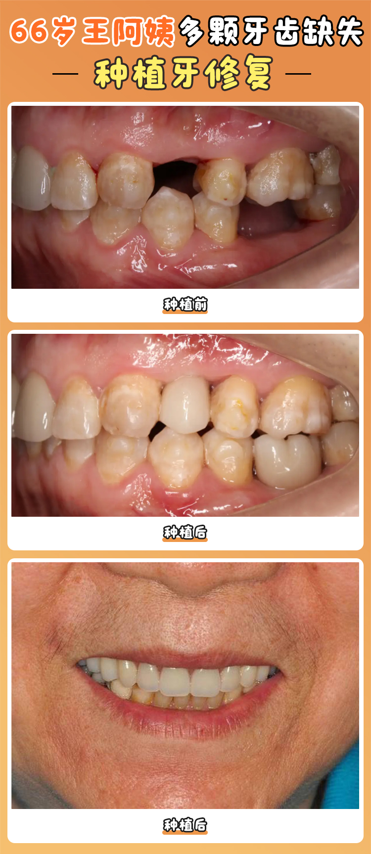 北京好牙口腔門診部種植牙實力強(qiáng)在哪