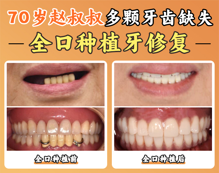 穿顴技術(shù)攻克高難度種植難題