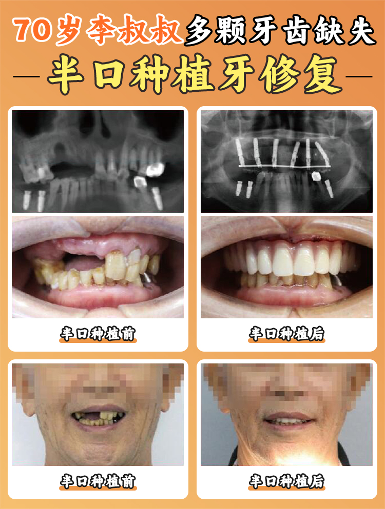 數(shù)字化導(dǎo)航技術(shù)助力精細(xì)種植牙