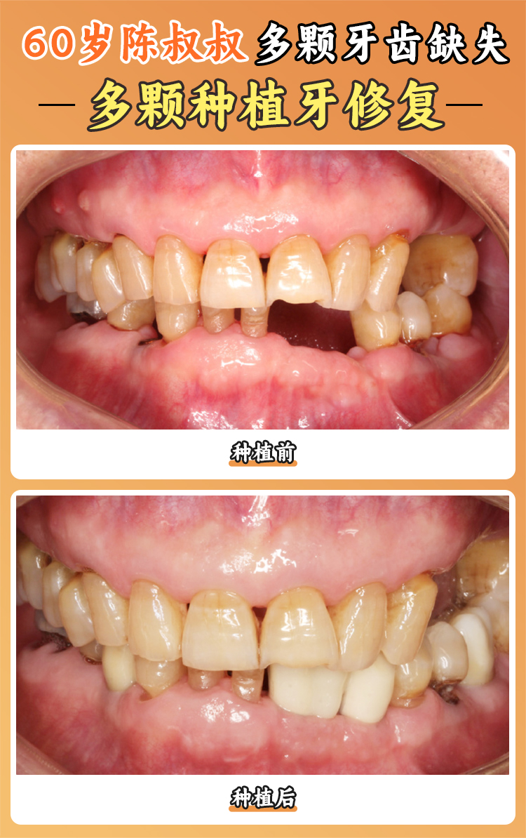口腔種植天團(tuán)：劉曉勤+陳高遠(yuǎn)，數(shù)字化種牙當(dāng)天用，999元起超親民
